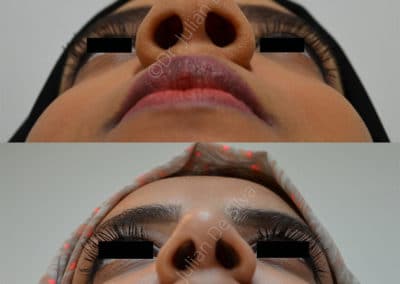 Rhinoplasty in London Before & After Results