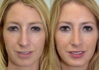 Rhinoplasty in London Before & After Results