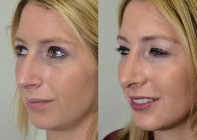 Rhinoplasty in London Before & After Results