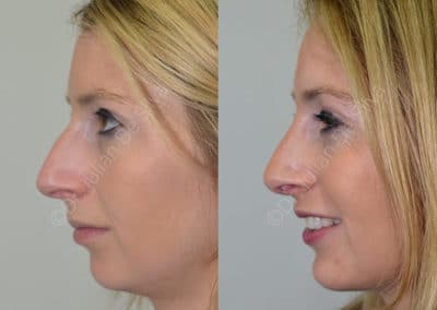 Rhinoplasty in London Before & After Results