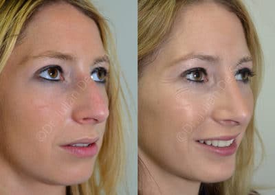 Rhinoplasty in London Before & After Results