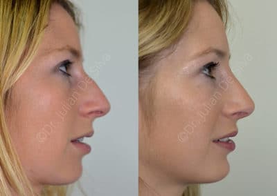 Rhinoplasty in London Before & After Results