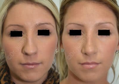 Rhinoplasty in London Before & After Results