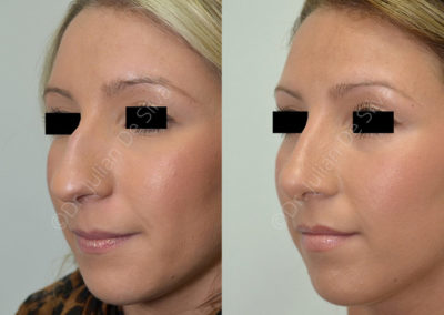 Rhinoplasty in London Before & After Results