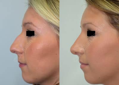 Rhinoplasty in London Before & After Results