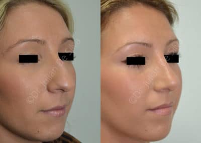 Rhinoplasty in London Before & After Results