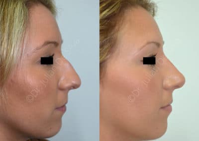 Rhinoplasty in London Before & After Results