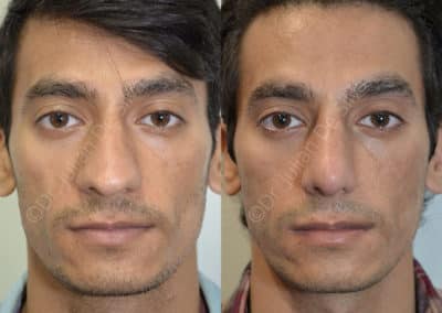 Rhinoplasty in London Before & After Results