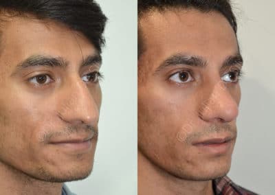 Rhinoplasty in London Before & After Results