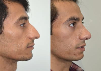 Rhinoplasty in London Before & After Results