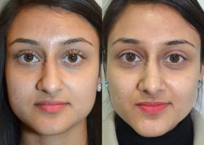 Rhinoplasty in London Before & After Results