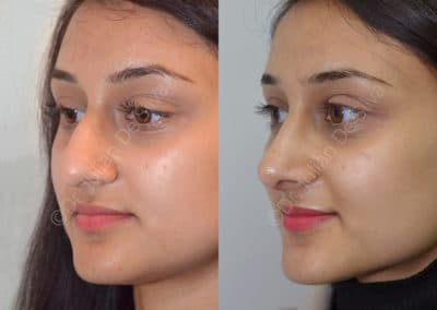 Rhinoplasty in London Before & After Results