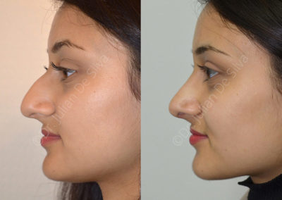 Rhinoplasty in London Before & After Results