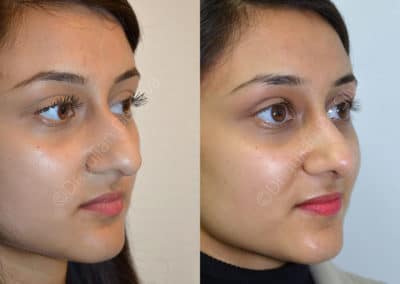 Rhinoplasty in London Before & After Results