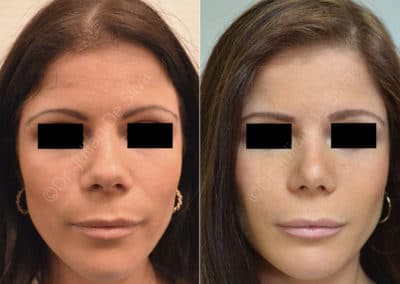 Rhinoplasty in London Before & After Results