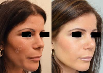 Rhinoplasty in London Before & After Results