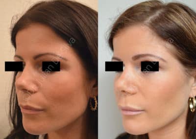 Rhinoplasty in London Before & After Results