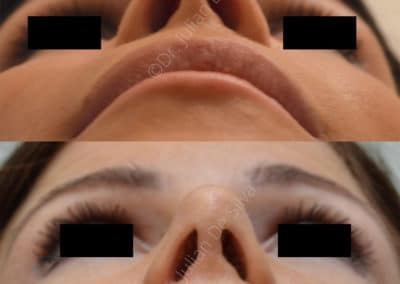 Rhinoplasty in London Before & After Results