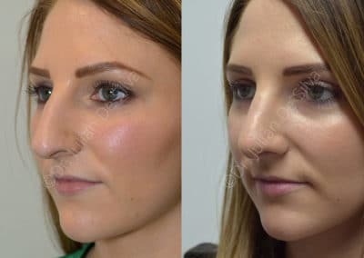 Rhinoplasty in London Before & After Results