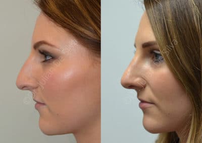 Rhinoplasty in London Before & After Results