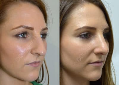 Rhinoplasty in London Before & After Results