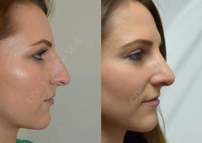 Rhinoplasty in London Before & After Results