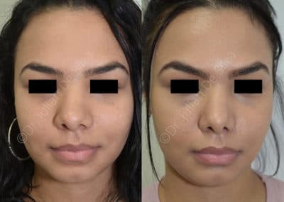 Rhinoplasty in London Before & After Results