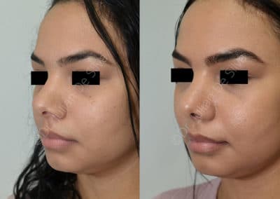 Rhinoplasty in London Before & After Results