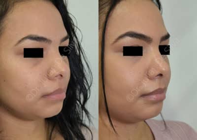 Rhinoplasty in London Before & After Results