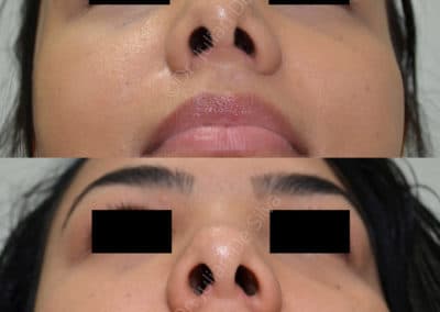 Rhinoplasty in London Before & After Results