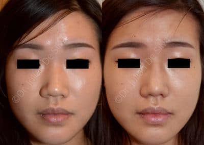 Rhinoplasty in London Before & After Results