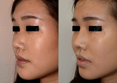 Rhinoplasty in London Before & After Results