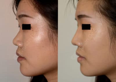 Rhinoplasty in London Before & After Results