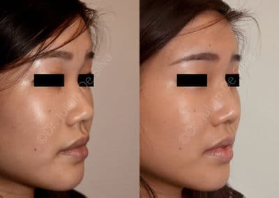 Rhinoplasty in London Before & After Results