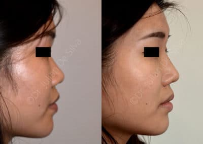 Rhinoplasty in London Before & After Results