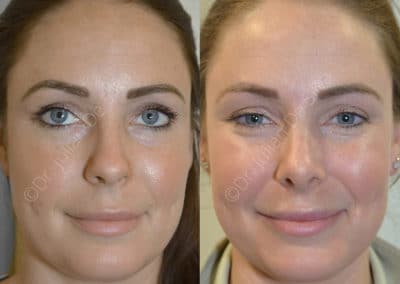 Rhinoplasty in London Before & After Results