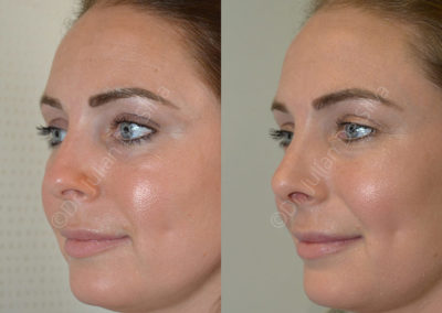 Rhinoplasty in London Before & After Results