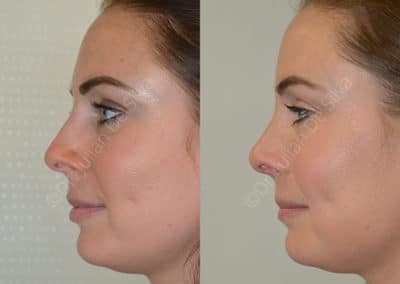 Rhinoplasty in London Before & After Results