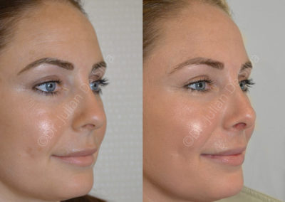 Rhinoplasty in London Before & After Results