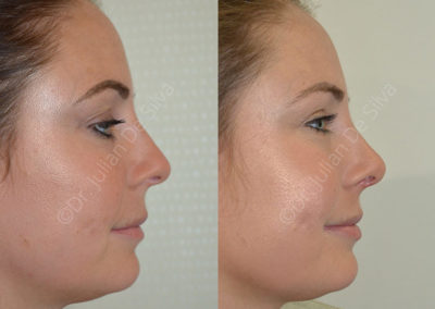 Rhinoplasty in London Before & After Results