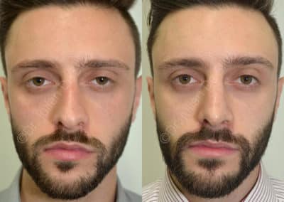 Rhinoplasty in London Before & After Results