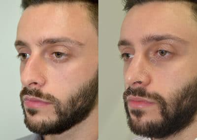 Rhinoplasty in London Before & After Results