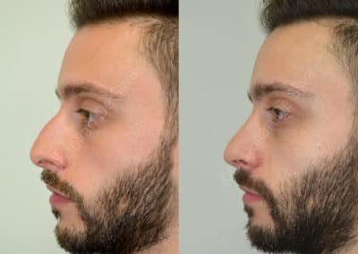 Rhinoplasty in London Before & After Results