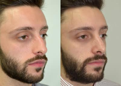 Rhinoplasty in London Before & After Results