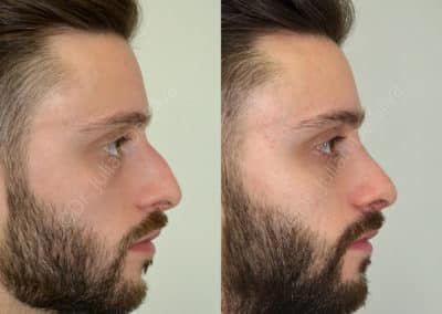 Rhinoplasty in London Before & After Results