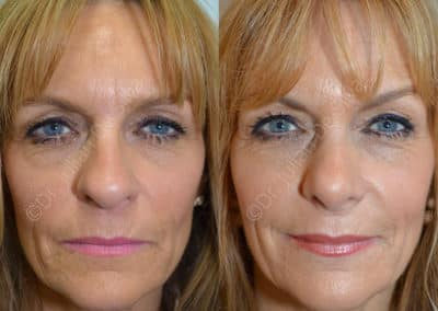 Rhinoplasty in London Before & After Results