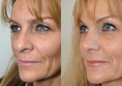 Rhinoplasty in London Before & After Results