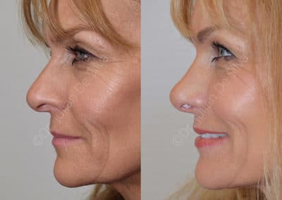 Rhinoplasty in London Before & After Results