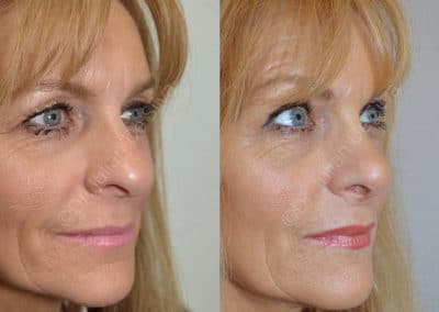 Rhinoplasty in London Before & After Results