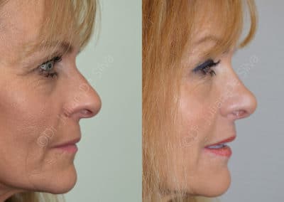 Rhinoplasty in London Before & After Results